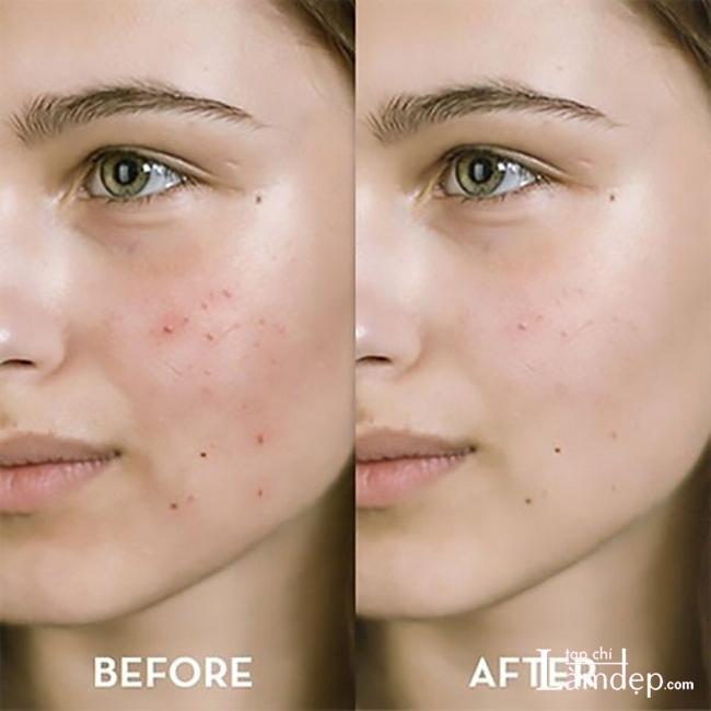 Trước và sau khi dùng Murad Post-Acne Spot Lightening