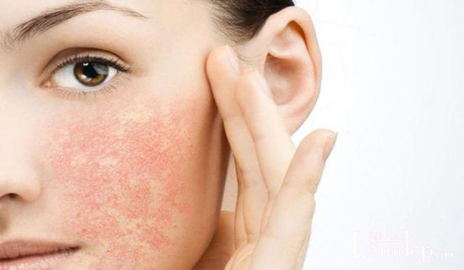 Da mụn, nhờn không sử dụng kem chống nắng để chăm sóc da mặt vì sẽ dễ tạo ra kích ứng và tổn thương da