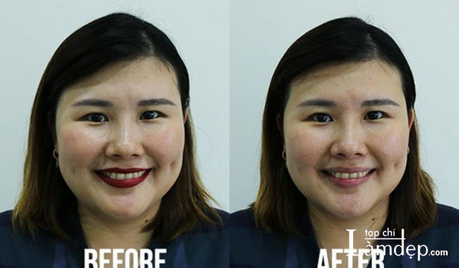 Kristen Juliet trước và sau khi sử dụng Bioderma Hydrabio H2O Micellar Water với một miếng bông cho toàn bộ khuôn mặt (trừ vùng mắt và môi)