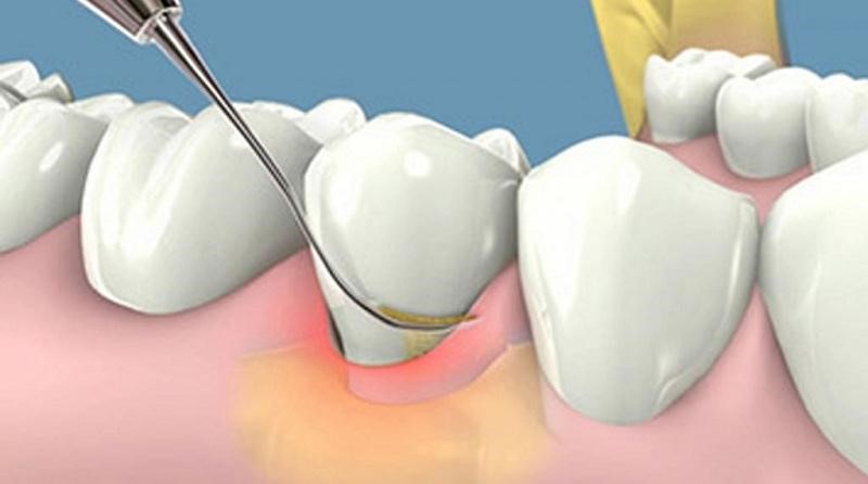 Chi phí cho mỗi lần lấy vôi răng phụ thuộc vào mức độ vôi răng