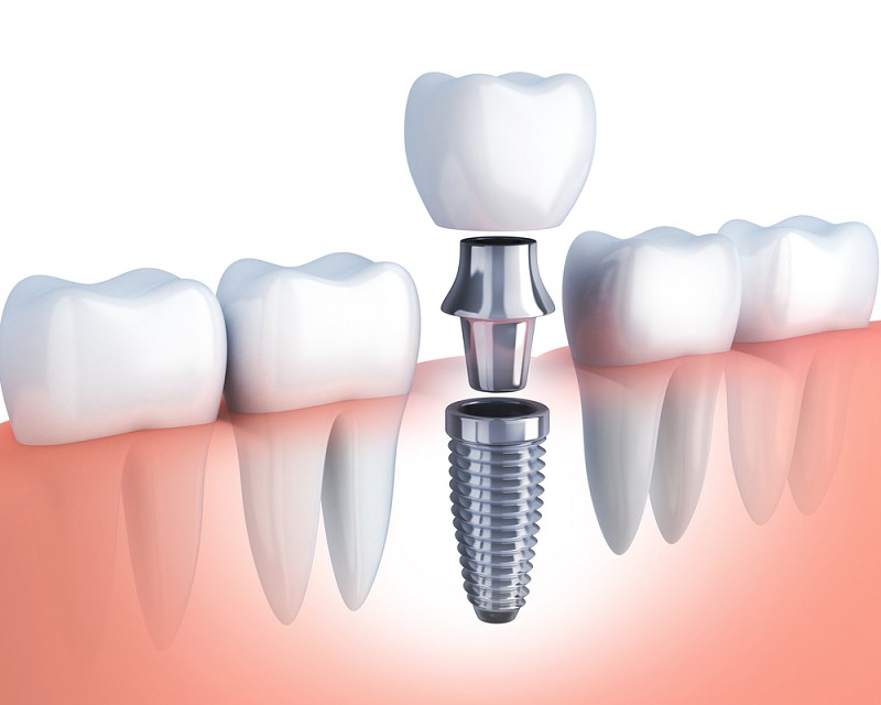 Kỹ thuật cấy răng implant phù hợp với nhiều đối tượng