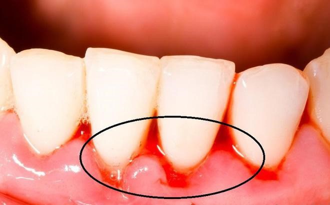 Lấy vôi răng là thao tác nhẹ nhàng không gây đau