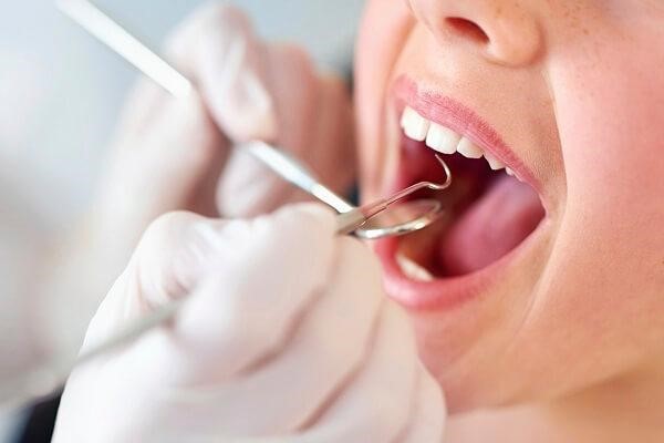 Nên kiểm tra và lấy cao răng định kỳ từ 3 – 6 tháng/lần