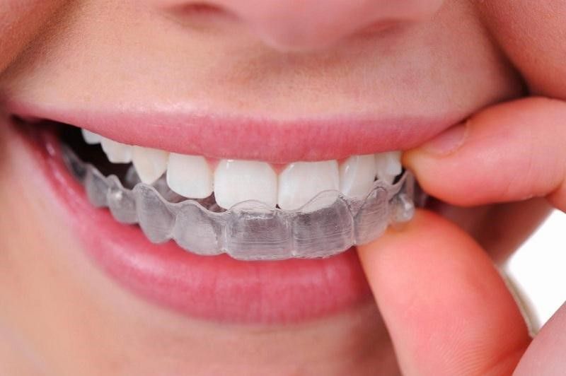 Niềng răng Invisalign trong suốt