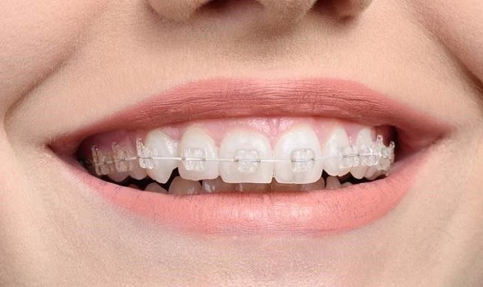 Niềng răng mất bao lâu và hết bao nhiêu tiền?