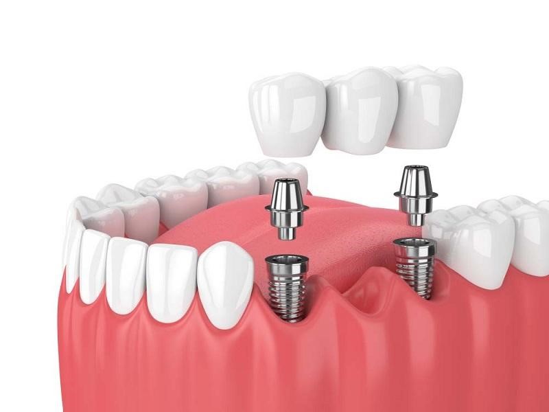 Phục hình răng sứ trên implant