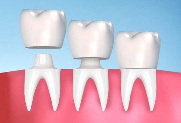 Thời gian bọc răng sứ kéo dài từ 5 – 7 ngày