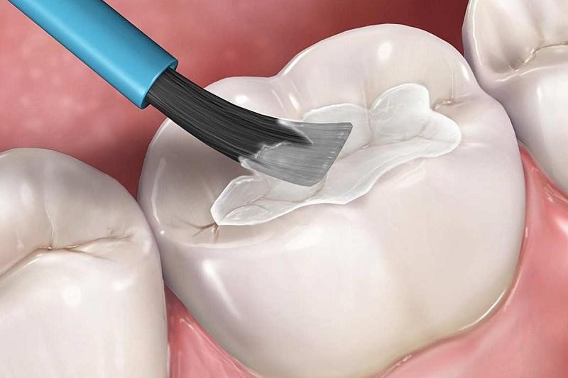 Trám răng là một kỹ thuật đơn giản hầu như không gây đau nhức