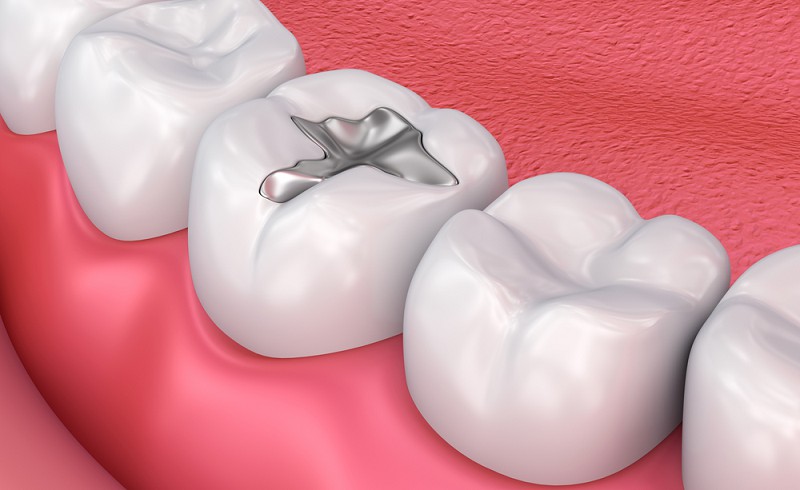 Vật liệu trám răng gồm 4 nhóm cơ bản
